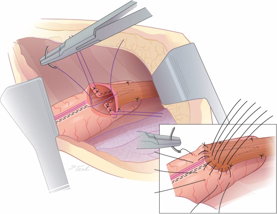 Œsophagectomie mini-invasive