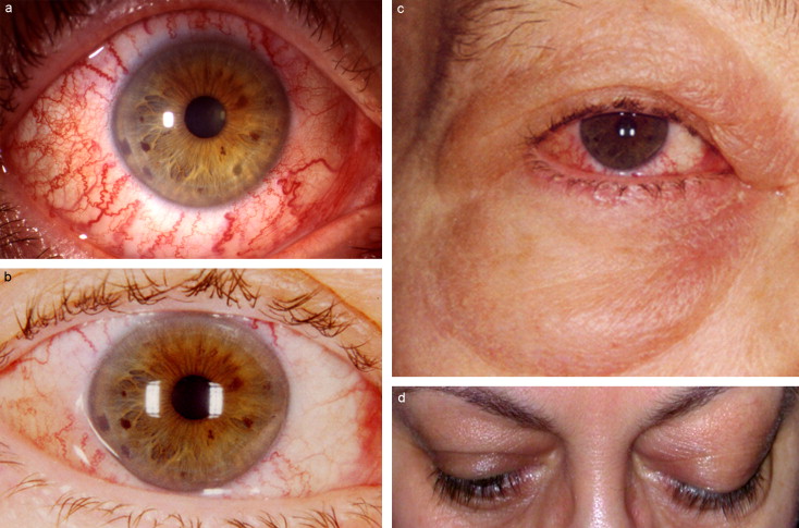 Fistule carotidocaverneuse