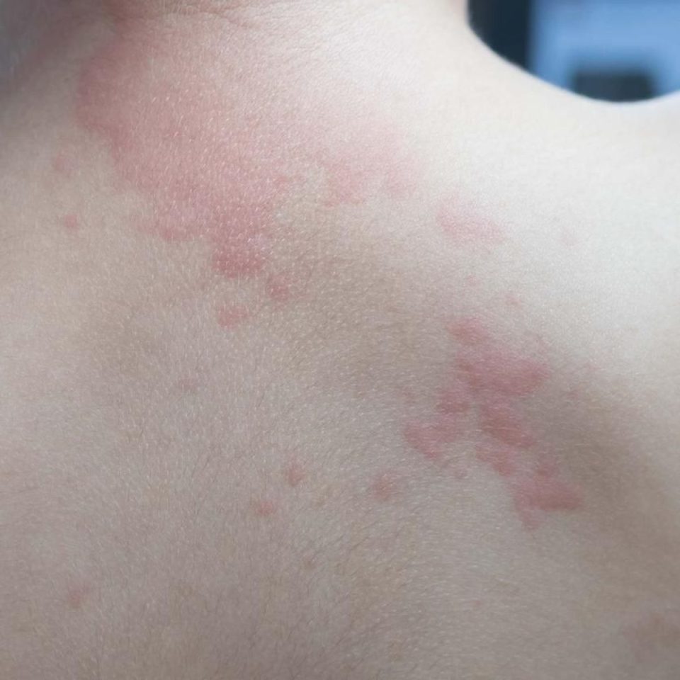 Urticaire allergique