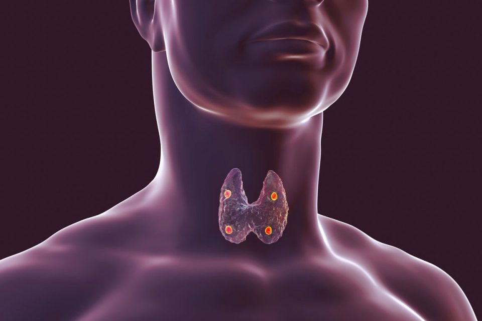 Cancer de la parathyroïde