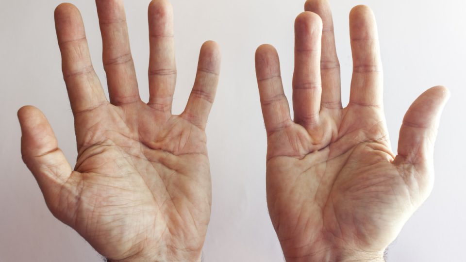 Maladie (contracture) de Dupuytren