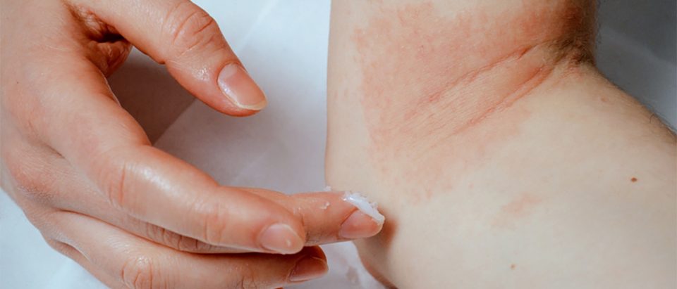 Psoriasis-en-gouttes
