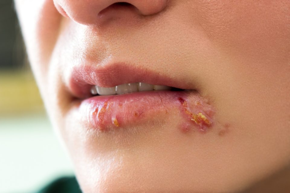 Herpes-genital