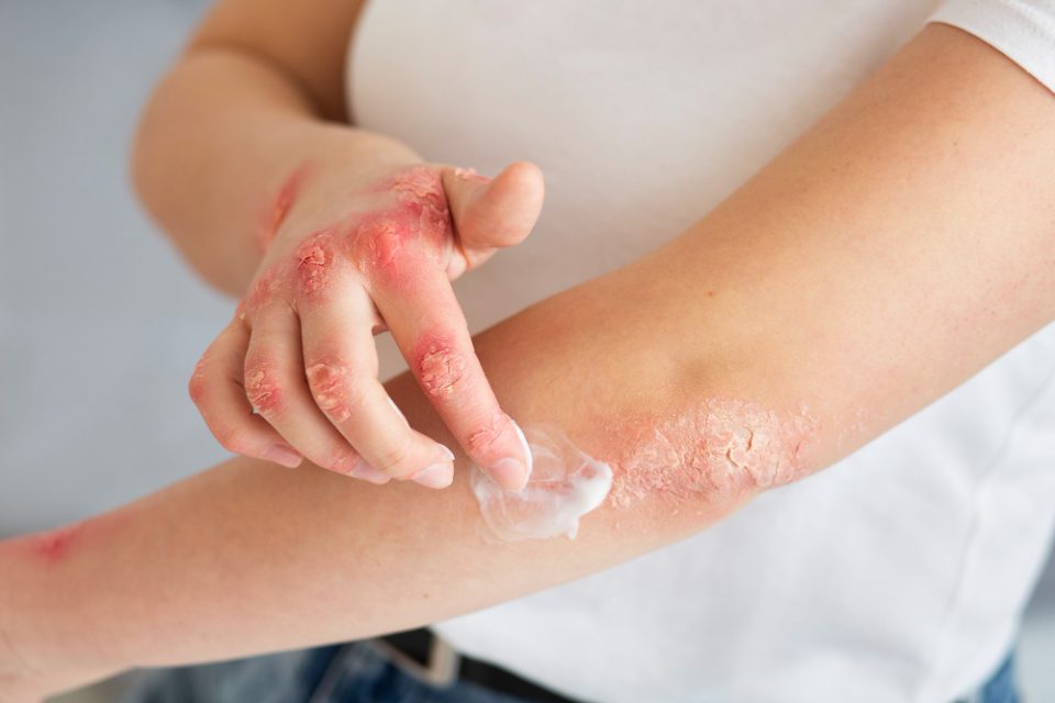 eczéma